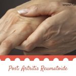 Artritis Reumatoide